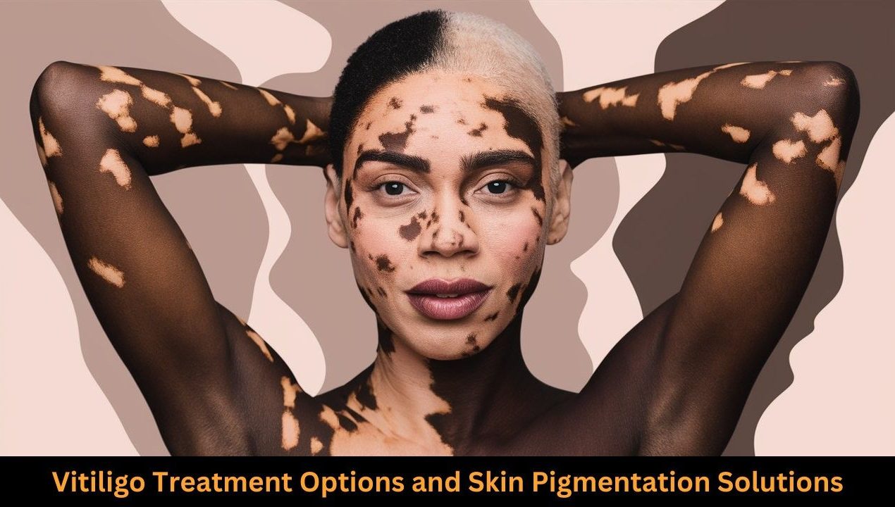 How to Treat Vitiligo Skin Disease Disorder